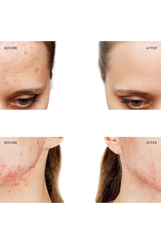 Уред за лечение на акне със синя led светлина FOREO ESPADA 2 Cobalt Blue F0538