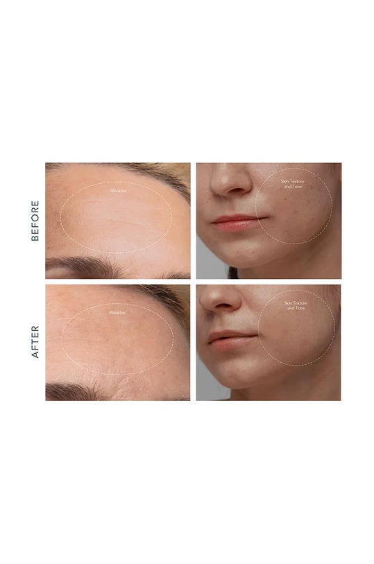 FOREO dispozitiv de microdermabraziune și curățare a porilor KIWI derma F1955